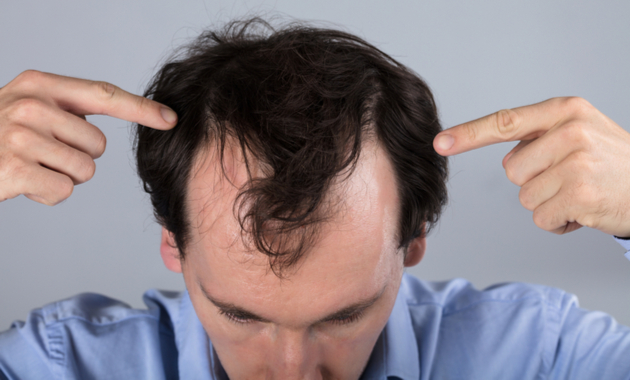What is Hair loss? Tips to Stop Hair Fall in 2023